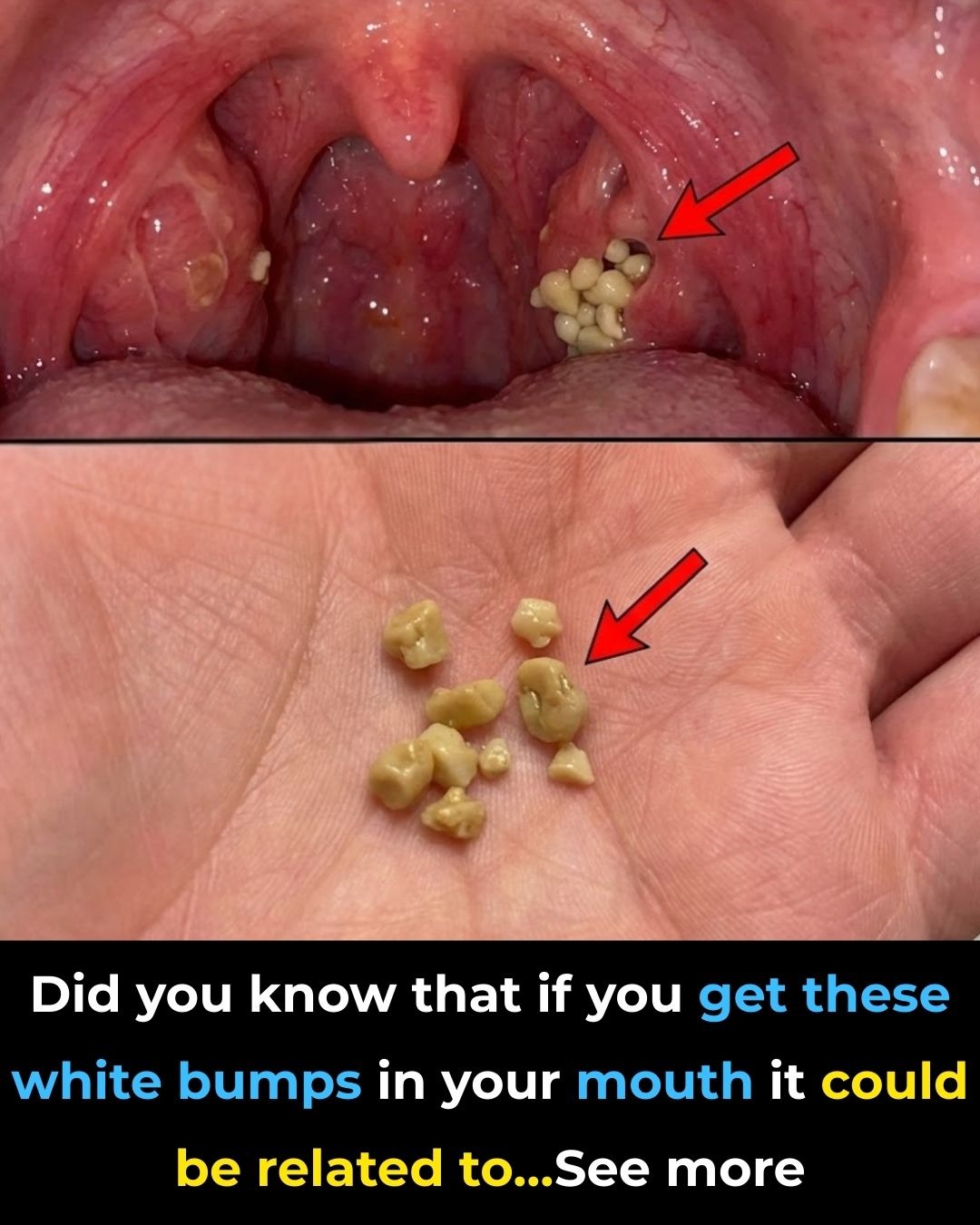 Tonsil Stones: Discover what they are, how they appear, and how to get rid of them forever.